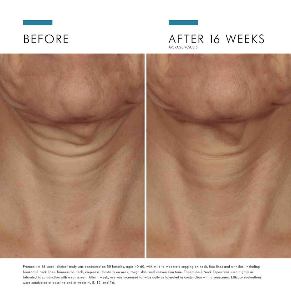 Tripeptide-R Neck Repair